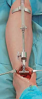 أعراض ألم الكاحل