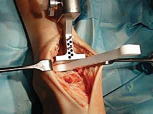 التميز الطبي في جراحة العظام