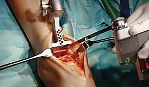 مقارنة العلاجات الجراحية للكاحل