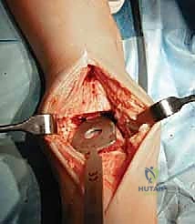 تآكل الغضاريف في الكاحل