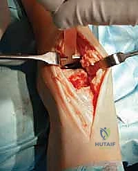 التهاب مفصل الكاحل