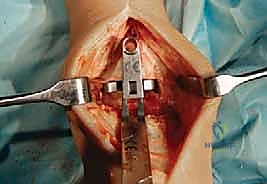 الشق الجراحي الدقيق