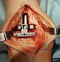 صورة طبية: استبدال مفصل الكاحل الكلي: استعادة الحركة والتخلص من الألم مع الأستاذ الدكتور محمد هطيف