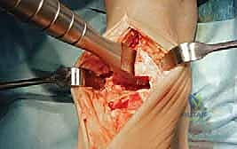 تحميل الوزن التدريجي