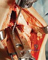 المكونات المعدنية والبلاستيكية للمفصل