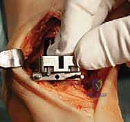 استخدام العكازات بعد الجراحة