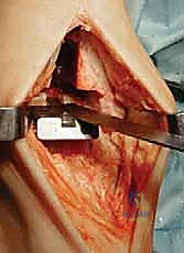 دقة القطع العظمي