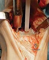 إزالة الغضاريف التالفة