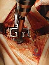 الانتهاء من الجراحة بنجاح