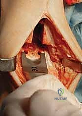 صورة طبية: استبدال مفصل الكاحل الكلي: استعادة الحركة والتخلص من الألم مع الأستاذ الدكتور محمد هطيف