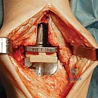 صورة توضيحية لـ استبدال مفصل الكاحل الكلي: استعادة الحركة والتخلص من الألم مع الأستاذ الدكتور محمد هطيف