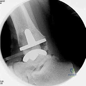 الأشعة المقطعية للكاحل