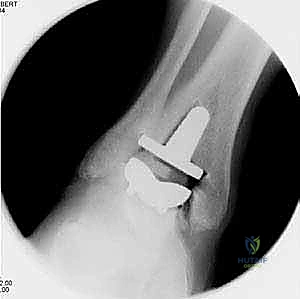 صورة طبية: استبدال مفصل الكاحل الكلي: استعادة الحركة والتخلص من الألم مع الأستاذ الدكتور محمد هطيف