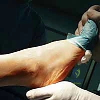 صورة طبية: استبدال مفصل الكاحل الكلي: استعادة الحركة والتخلص من الألم مع الأستاذ الدكتور محمد هطيف