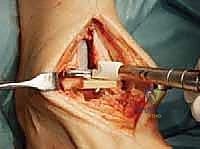 صورة توضيحية لـ استبدال مفصل الكاحل الكلي: استعادة الحركة والتخلص من الألم مع الأستاذ الدكتور محمد هطيف