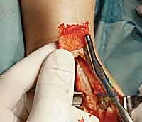 أسباب تلف الكاحل