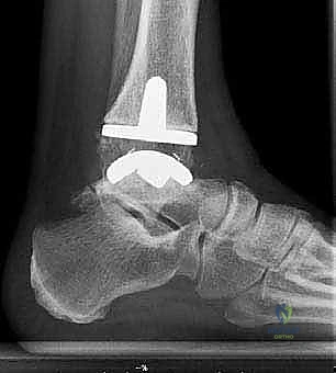 استعادة التوازن والمشي الطبيعي