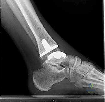 صورة طبية: استبدال مفصل الكاحل الكلي: استعادة الحركة والتخلص من الألم مع الأستاذ الدكتور محمد هطيف