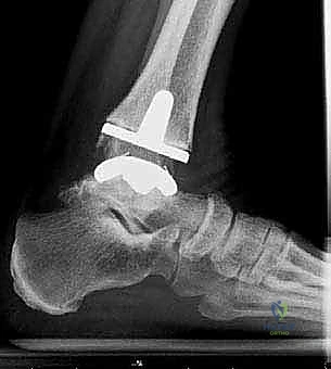 صورة طبية: استبدال مفصل الكاحل الكلي: استعادة الحركة والتخلص من الألم مع الأستاذ الدكتور محمد هطيف