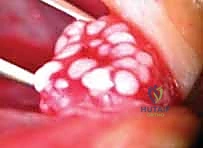 تفاصيل جراحية دقيقة لترميم الأعصاب