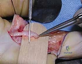 صورة توضيحية لـ إصابات الأعصاب الطرفية في اليد والمعصم والساعد