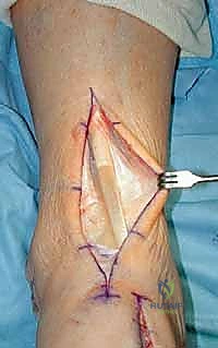 استبدال مفصل الكاحل الكلي بنظام INBONE: استعادة الحركة بلا ألم مع الأستاذ الدكتور محمد هطيف في صنعاء