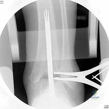 الأشعة السينية توضح احتكاك العظام في مفصل الكاحل