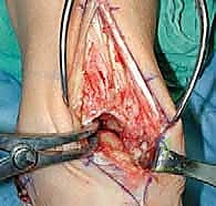 تأثير التهاب المفاصل الروماتويدي على مفصل الكاحل