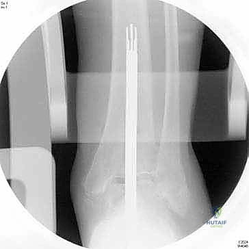 تشريح مفصل الكاحل وتوضيح العظام المشاركة في الحركة