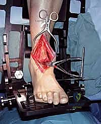 الشق الجراحي الأمامي للكاحل