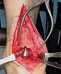 تركيب المكونات المعدنية والبلاستيكية للمفصل