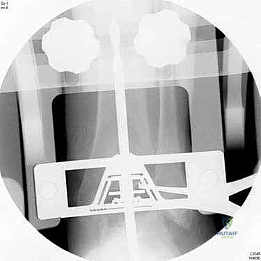 استخدام أدوات التوجيه الجراحية الدقيقة