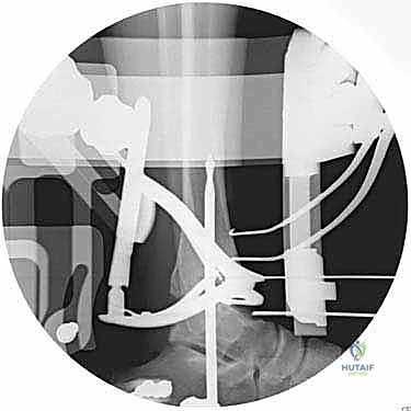 فحص المدى الحركي والمحاذاة بالأشعة في غرفة العمليات