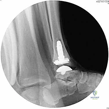 صورة توضيحية لـ استبدال مفصل الكاحل الكلي بنظام INBONE: استعادة الحركة بلا ألم مع الأستاذ الدكتور محمد هطيف في صنعاء