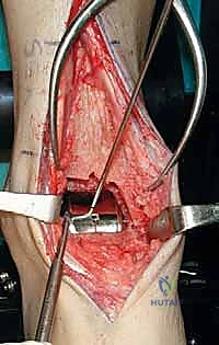 تطور قدرة المريض على المشي خلال فترة التعافي