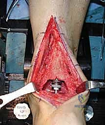 مريض يستعيد قدرته على المشي بثقة بعد العملية