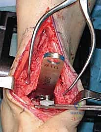 دقة التثبيت داخل النقي لعظمة الساق