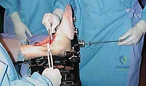 المفصل الصناعي بعد تركيبه بالكامل