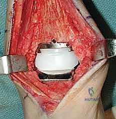 صورة توضيحية لـ استبدال مفصل الكاحل الكلي بنظام INBONE: استعادة الحركة بلا ألم مع الأستاذ الدكتور محمد هطيف في صنعاء