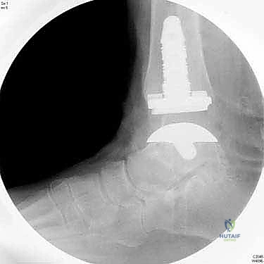 تآكل الغضروف المفصلي في الكاحل وتأثيره على العظام