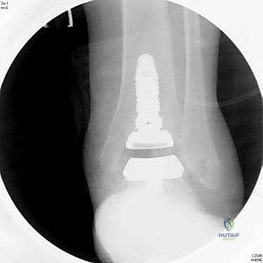 صورة توضيحية لـ استبدال مفصل الكاحل الكلي بنظام INBONE: استعادة الحركة بلا ألم مع الأستاذ الدكتور محمد هطيف في صنعاء