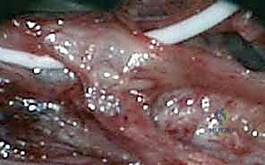 Illustration of injuries in continuity - Dr. Mohammed Hutaif