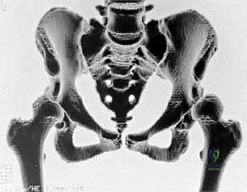 تشريح مفصل الورك وخلل التنسج