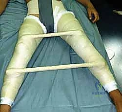 العوامل المسببة لخلل تنسج الورك