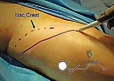 التخطيط الجراحي باستخدام التصوير المقطعي