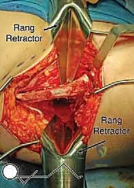 نتائج العلاج التحفظي مقابل الجراحي