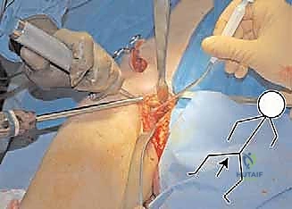 صورة توضيحية لـ جراحة قطع عظم الحوض الثلاثي