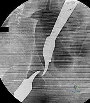 تأثير خلل التنسج على ميكانيكا المشي