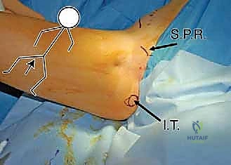 تدوير التجويف الحقي للحصول على التغطية المثلى