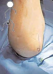 تثبيت العظام باستخدام براغي التيتانيوم